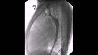 Balloon angioplasty of coarctation of aorta [upl. by Hamilton710]