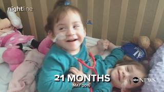 Formerly conjoined twin sisters celebrate their 3rd birthday after undergoing successful separation [upl. by Eeluj501]