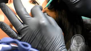 MicroDermal Procedure [upl. by Iru]