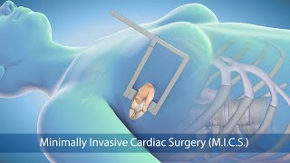 Medical Animation Minimally Invasive Cardiac Surgery MICS at Sarasota Memorial Hospital [upl. by Midge]