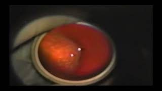 Retinal detachment Encircling laser retinopexy technique  Supplementary video 1 ID 406337 [upl. by Philpot]