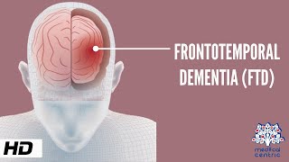 Frontotemporal Dementia Causes Signs and Symptoms Diagnosis and Treatment [upl. by Nikal]