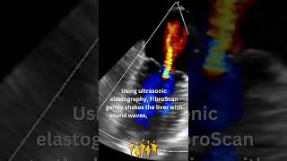 Meet the FibroScan [upl. by Ardelle]