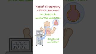 Neonatal respiratory distress syndrome diagnosis and treatment [upl. by Fernanda]