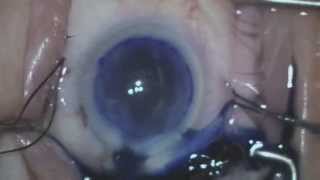 DMEK corneal transplant surgery Shannon Wong MD 52215 [upl. by Korfonta]