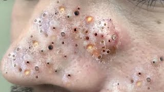 Big Cystic Acne Blackheads Extraction Blackheads amp Milia Whiteheads Removal Pimple Popping  9198 [upl. by Lyckman912]