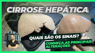 Cirrose Hepática Anatomia Sintomas e Tratamento com Demonstração Prática [upl. by Essilevi]