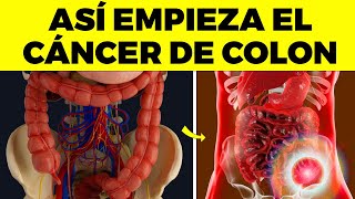 Las 10 PRIMERAS SEÑALES de CÁNCER DE COLON que nunca debes ignorar [upl. by Ahsaret418]