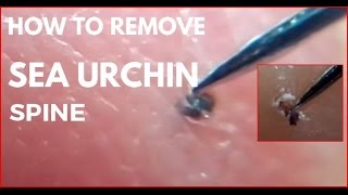 How to remove sea urchin spine [upl. by Siurad]