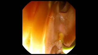 Pancreatic duct stent placement [upl. by Farrison]