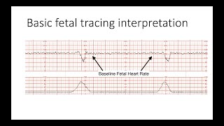 Interpreting Intrapartal fetal heart rate tracings [upl. by Eeroc]