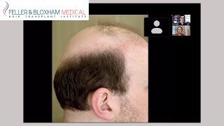 Can a Norwood 7 VII Patient Have a Hair Transplant  Dr Bloxham amp Dr Parissis  Feller amp Bloxham [upl. by Ellenet]