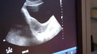 How to Perform Transabdominal Ultrasound [upl. by Ahsain]