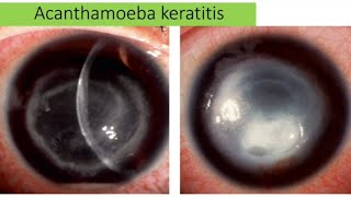 Acanthamoeba keratitis  causes sign clinical pictures management [upl. by Oralle]