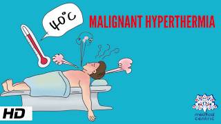 MALIGNANT HYPERTHERMIA Causes Signs and Symptoms Diagnosis and Treatment [upl. by Nirmak]