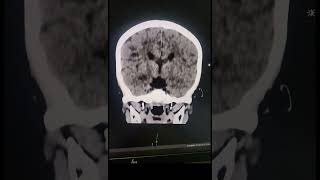 Corpus Callosum Agenesis  Radiology [upl. by Weintrob169]