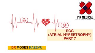 ECG Atrial enlargement Part 7 [upl. by Annaek]