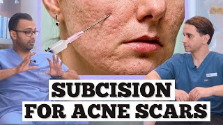 Subcision Acne Scars  Minor Surgery For Acne Scarring  Dr Somji amp Dr Solomon Explain Acne Scars [upl. by Lithea414]