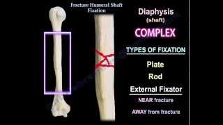 Humeral Shaft fracture Fixation  Everything You Need To Know  Dr Nabil Ebraheim [upl. by Tati]