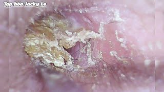 Ear Wax Removal 118 The Earwax Is So Dry And Sticky That It Hurts My Ears  Ear Cleaning ASMR [upl. by Skinner]