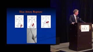 Endovascular Treatment of IliofemoralSFA Occlusion [upl. by Ttoille]