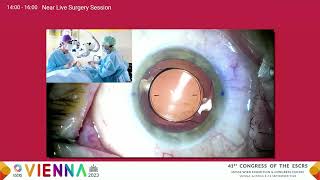 Peer2Peer  ESCRS 2023 Prof Michael Amon PreLive Surgery [upl. by Aneleasor]