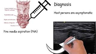 Most common thyroid cancer  Papillary thyroid carcinoma symptoms treatment and prognosis [upl. by Whitelaw]