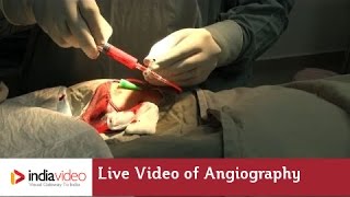 Live Video of Angiography at Lisie Hospital  How angiography is done [upl. by Elohc52]