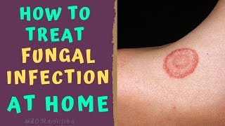 HOW TO TREAT SKIN FUNGAL INFECTION INFECTION AT HOME TINEA RINGWORM REMEDIES HOW TO CURE [upl. by Kato]