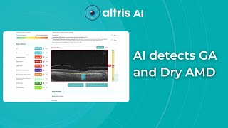 AI detects Dry AMD on OCT scan [upl. by Yeleek]