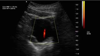 Jet ureterovescicale ingresso di urina in vescica al powerDoppler [upl. by Ahsitan]