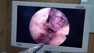 Endoscopic Transorbital Approach [upl. by Eirot822]