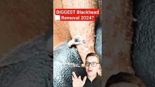 BIGGEST BLACKHEADS REMOVAL EVER  Extreme Blackheads on Cheek shorts [upl. by Blockus]