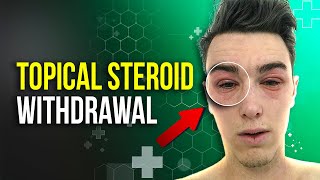 Topical Steroid Withdrawal TSW amp how to treat [upl. by Vick]