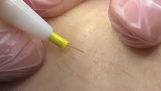 Electrolysis hair removal [upl. by Dronski67]