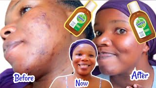 HOW TO USE DETTOL ANTISEPTIC LIQUID TO TREAT PIMPLES  ACNE DARK SPOTS SCARS amp HYPERPIGMENTATION [upl. by Malachy476]