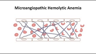 Microangiopathic Hemolytic Anemia [upl. by Asseralc751]