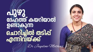 പുഴു ദേഹത്ത് കയറിയാൽ  വീട്ടിൽ ചെയ്യാവുന്ന പൊടിക്കൈകൾ  Dr Jaquline Mathews BAMS [upl. by Akirrehs]