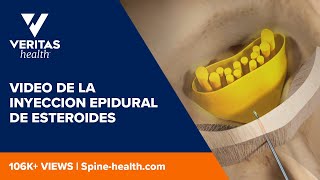 Video de la inyeccion epidural de esteroides [upl. by Cutcliffe327]