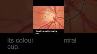 Examining the fundus – part 2 ophthalmology [upl. by Eilarol]