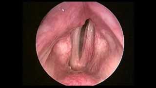 左側聲帶麻痺術前left vocal fold paralysis preop [upl. by Rand]