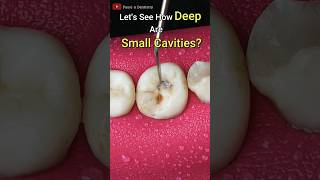 Tooth cavity  How to prepare tooth before filling dentaldoubts passiondentistry dentist [upl. by Fleisig]