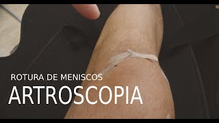 Día 17 Operación de Rodilla artroscopia rotura de menisco asa de cubo Mi experiencia [upl. by Daggett]