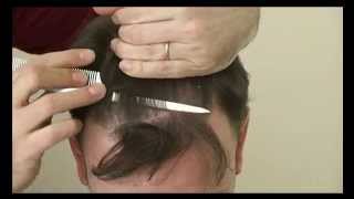 5889 FUT Hattingen Hair Transplantation Switzerland [upl. by Felicio]