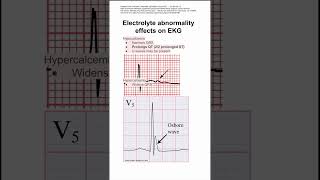 Electrolyte abnormality effects on EKG [upl. by Kendricks327]