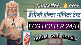 ecg holter monitor test  holter test results  holter monitor 24 hoursheart holter testviral [upl. by Acinok]