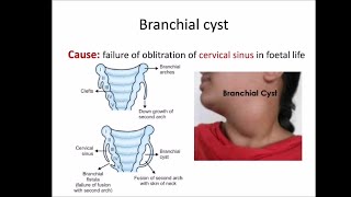 Branchial cyst [upl. by Llednyl]