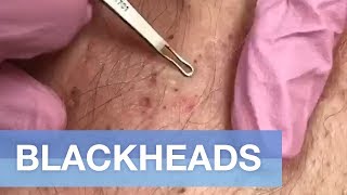 BlackHead Chloracne Extraction [upl. by Aciretal]