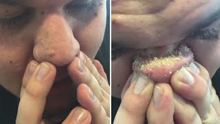 how to remove whiteheads from nose with hands [upl. by Atwekk]