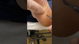 Expert Australian Podiatrist Removes Painful Corns with Precision [upl. by Joni]